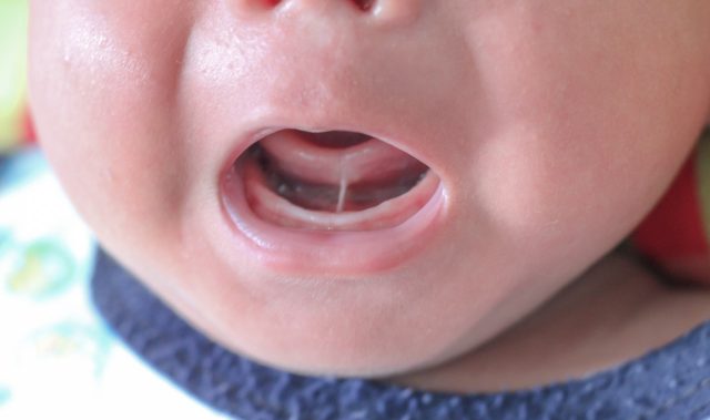 Tongue Tie Division Available at Paediatric Gut Investigation Clinic in Dorking, Surrey.