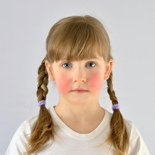 paediatric eczema